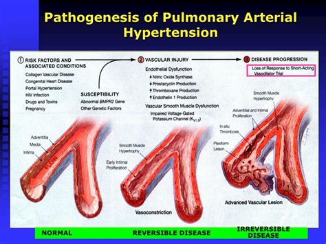 pulmoner hipertansiyon ppt